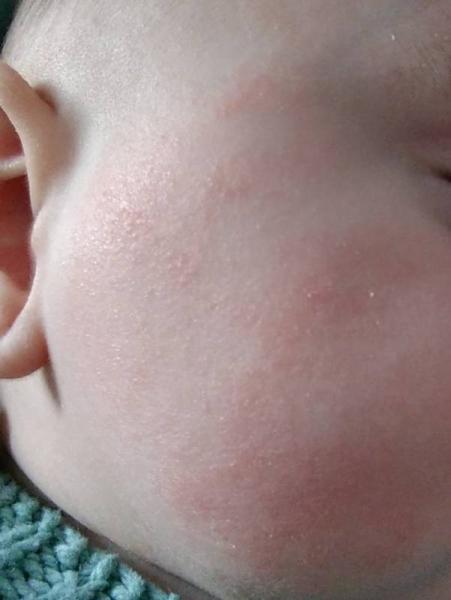 Bild zu Neurodermitis? Allergie? - Forum für Juli - Mamis