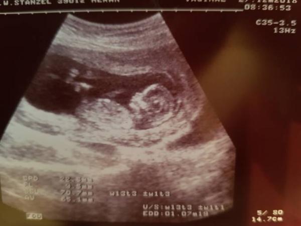 Bild zu 2. Ultraschall - Forum für Juli - Mamis