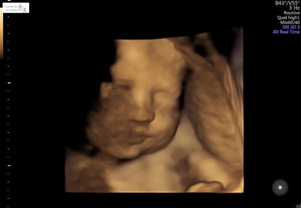 Bild zu 3. großer Ultraschall - Forum für Juli - Mamis