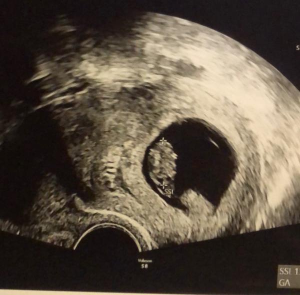 Bild zu Embryo sicher zu klein :( - Forum für Juli - Mamis