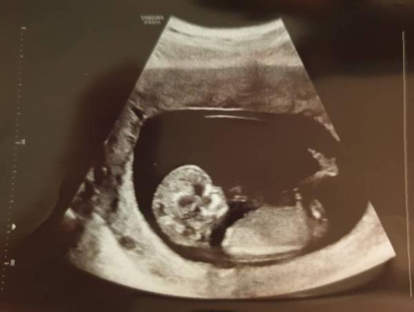 Bild zu 1. Großes Screening - Myom Erfahrungen? - Forum für Juli - Mamis