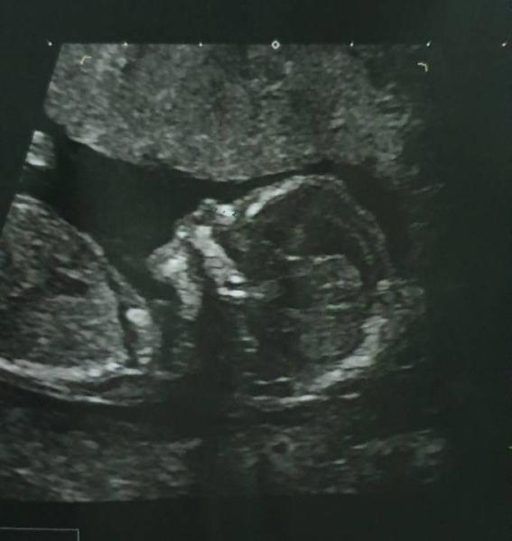 Bild zu Zurück von der Feindiagnostik - Forum für Juli - Mamis