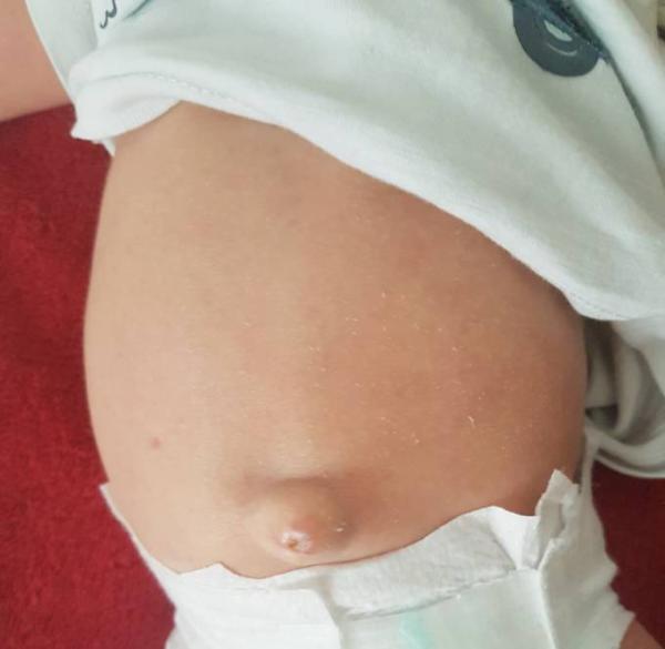 Bild zu Nabelbruch - Forum für Juli - Mamis