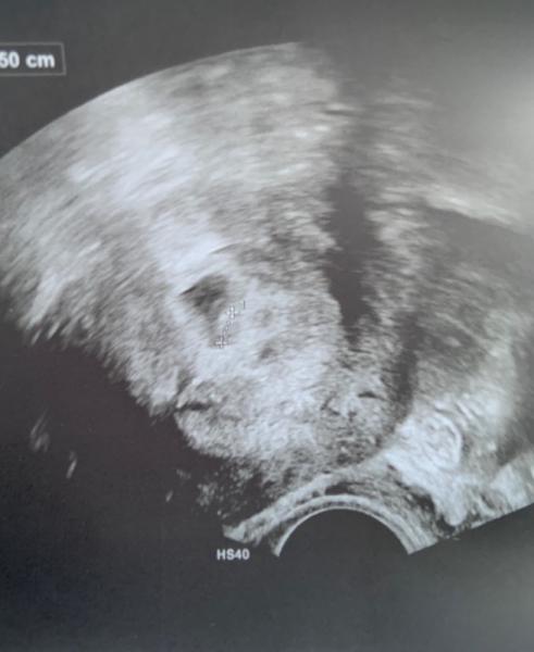 Bild zu Update.. wieder am zittern.. - Forum für Juli - Mamis