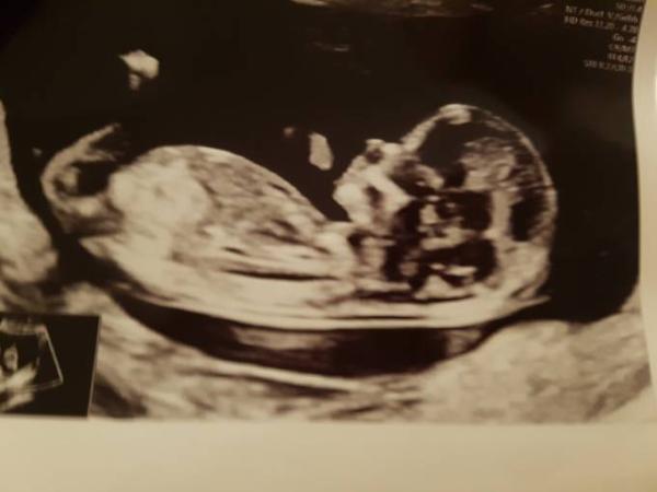 Bild zu Zurück von der Nackenfaltenmessung - Forum für Juli - Mamis