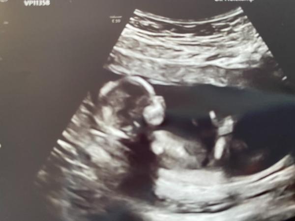 Bild zu Nackenfalte und Ultraschall - Forum für Juli - Mamis