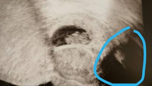 Bild zu Ultraschallbild Zwillinge? - Forum für Juli - Mamis