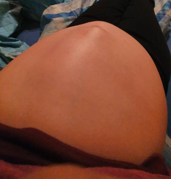 Bild zu Schmaler Buckel längs am Bauch? - Forum für Juli - Mamis