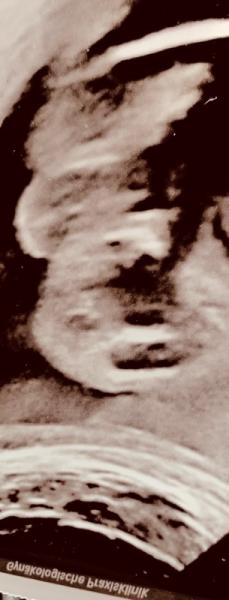 Bild zu 31 ssw und mein Arzt ist sich nicht sicher - Forum für Juli - Mamis