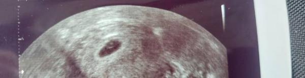Bild zu Zu Leere fruchthöhle? Angst vor Fehlgeburt - Forum für Juli - Mamis