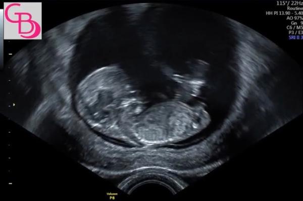 Bild zu NUB Theorie Mädchen oder Junge? - Forum für Juli - Mamis