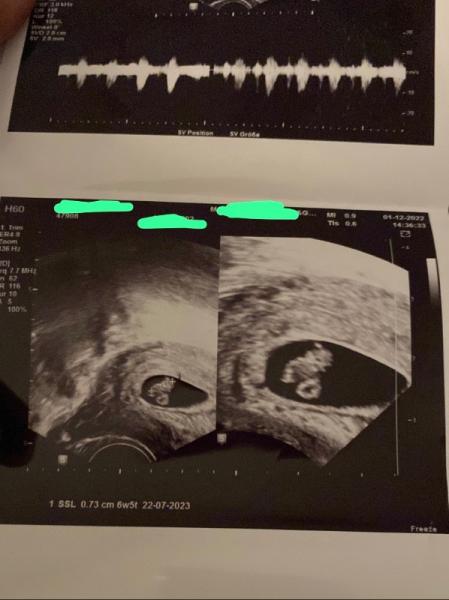 Bild zu Ich will mal mein Ultraschallbild herzeigen - Forum für Juli - Mamis