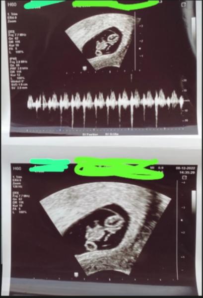 Bild zu US Bild 8+0 (9 ssw) - Forum für Juli - Mamis