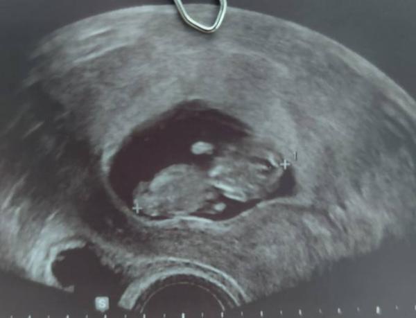 Bild zu Ersttrimester Screening und Harmony Test erledigt - Forum für Juli - Mamis
