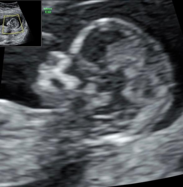 Bild zu Ersttrimester Screening + NIPT - Forum für Juli - Mamis