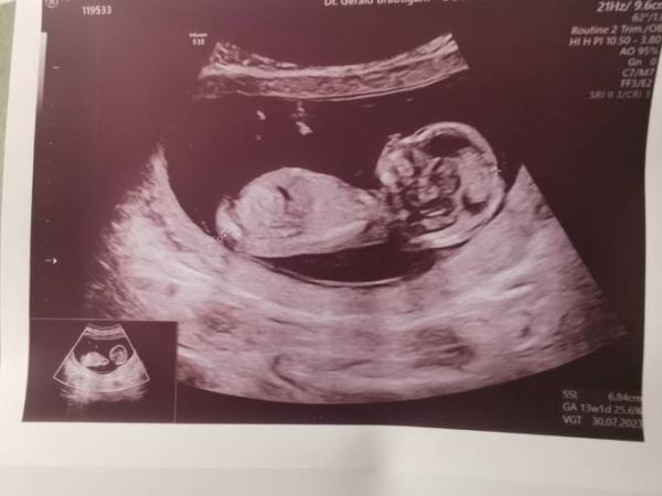Bild zu Ersttrimester-Screening - Forum für Juli - Mamis