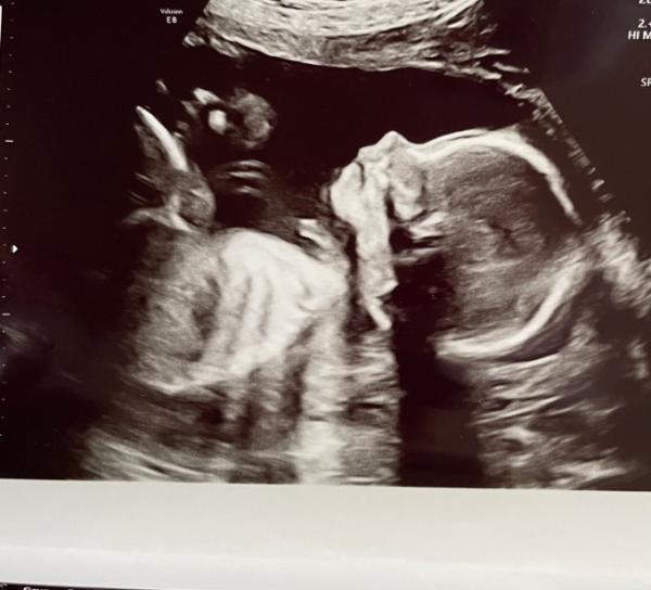 Bild zu Zweiter großer Ultraschall incl. „Geschlechtsumwandlung“ - Forum für Juli - Mamis