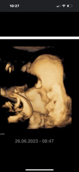 Bild zu Zweites Gesicht im Ultraschall - Forum für Juli - Mamis