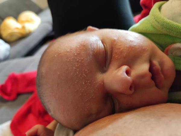 Bild zu Neugeborenen Akne - Forum für Juli - Mamis