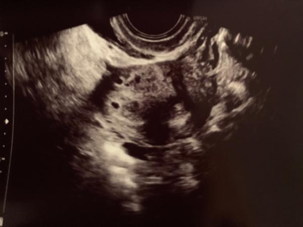 Bild zu Herzförmiger Uterus? - Forum für Juli - Mamis