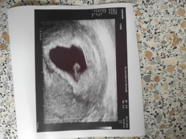 Bild zu Ungeplant erstes Ultraschall Bild - Forum für Juli - Mamis