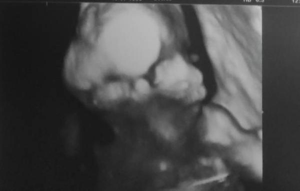 Bild zu Halbzeit - zweiter Ultraschall - Geschlecht - Forum für Juli - Mamis