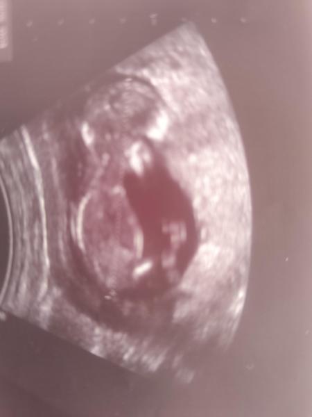 Bild zu Ssw13+1 kann jemand da was erkennen - Forum für Juli - Mamis