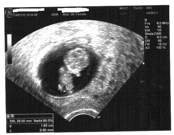 Bild zu mein Utraschallbid von letzter Woche! - Forum für August - Mamis