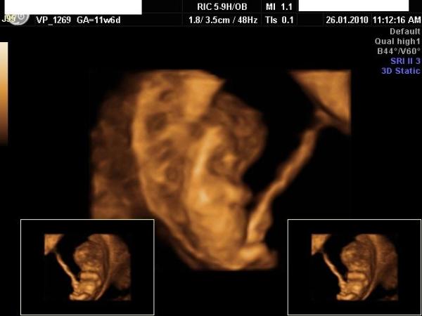 Bild zu Kontrolle nach Blutungen - Forum für August - Mamis