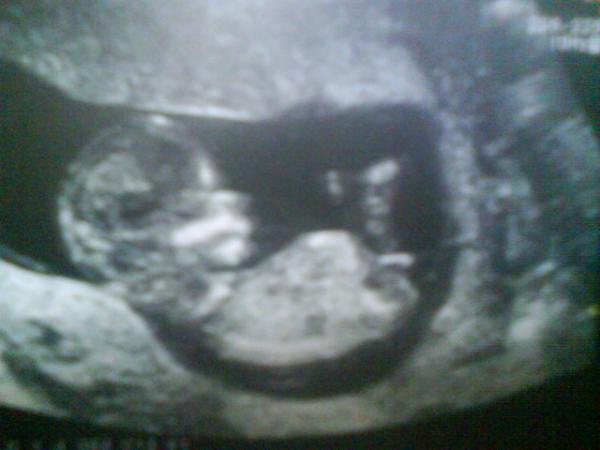 Bild zu Ultraschall 1. Trimester - Forum für August - Mamis