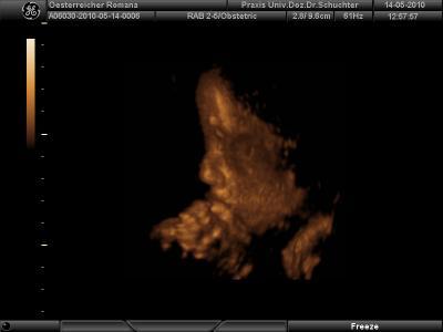 Bild zu 3D Ultraschall-Bilder - Forum für August - Mamis