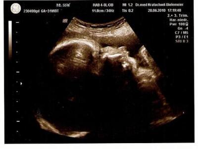 Bild zu große Vorsorgeuntersuchen 32. SSW - Forum für August - Mamis