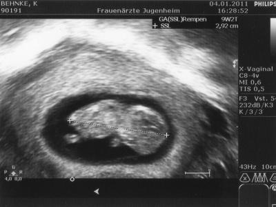 Bild zu Ultraschall - Forum für August - Mamis