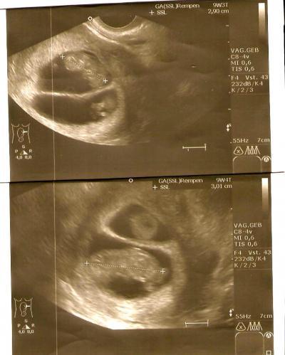 Bild zu Ultraschallbild von den Zwillis;) - Forum für August - Mamis