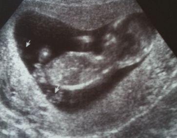 Bild zu Ultraschall Bild - Forum für August - Mamis