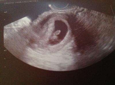 Bild zu Bericht vom Ultraschall - Forum für August - Mamis