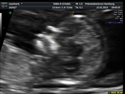 Bild zu Bericht der Nackenfaltenmessung - Forum für August - Mamis