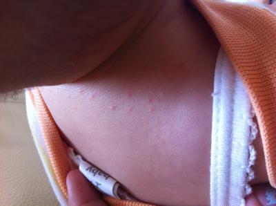 Bild zu Pickelchen im Halsbereich??? - Forum für August - Mamis