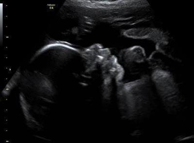 Bild zu FA Bericht mit Zuckertest - Forum für August - Mamis