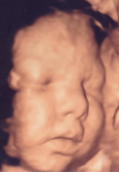 Bild zu Bericht pränatale Diagnostik - Forum für August - Mamis