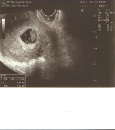 Bild zu mein 1.Ultraschallbild von heute 7+5SSW - Forum für August - Mamis