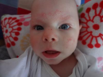 Bild zu Hautproblem...kann wer helfen? - Forum für August - Mamis