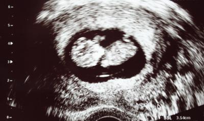 Bild zu Bericht vom Arztbesuch - wir haben ein Alien ;-) - Forum für August - Mamis