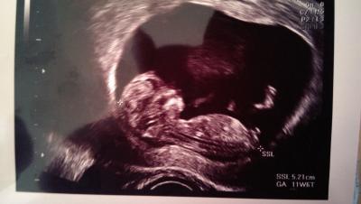 Bild zu 2 ultraschall - Forum für August - Mamis