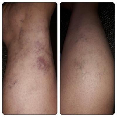 Bild zu Mein rechtes Bein sieht so schlimm aus :( - Forum für August - Mamis