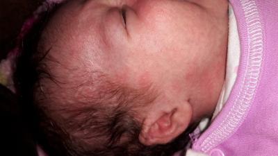 Bild zu ist das Baby Akne oder ausschlag??? - Forum für August - Mamis