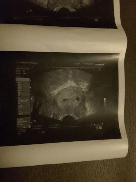 Bild zu Zwillinge !? wann würdet ihr noch mal zum Arzt? - Forum für August - Mamis