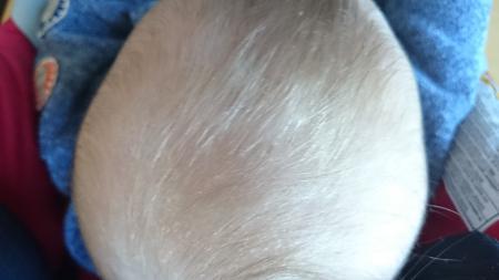 Bild zu Immer noch Kopfgneis - Forum für August - Mamis