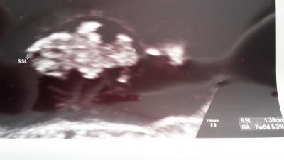 Bild zu Frage zum Ultraschallbild - Forum für August - Mamis