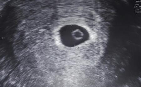 Bild zu Ultraschall gestern - Forum für August - Mamis
